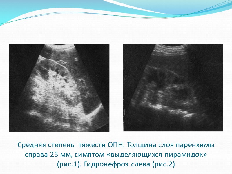 Средняя степень  тяжести ОПН. Толщина слоя паренхимы справа 23 мм, симптом «выделяющихся пирамидок»